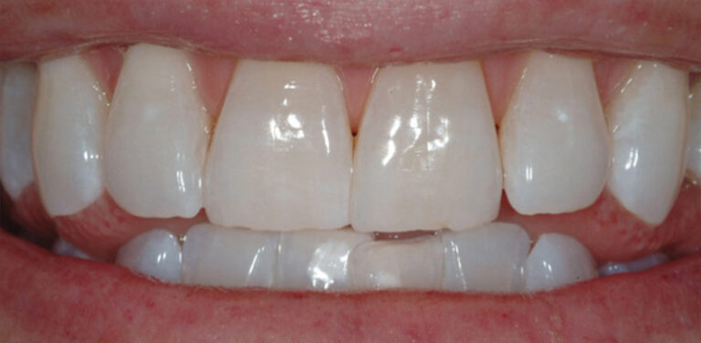 Nahaufnahme von Zähnen, nachdem eine Zahnaufhellung mittels Bleaching erfolgt ist.
