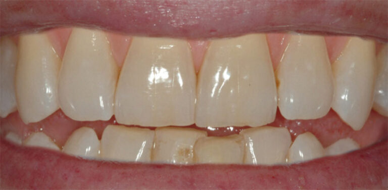 Nahaufnahme von Zähnen, bevor eine Zahnaufhellung mittels Bleaching erfolgt ist.