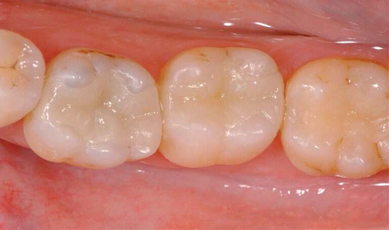 Nahaufnahme einer Zahnreihe nach dem Einsatz von Kompositfüllungen. Die optisch unschönen alten Füllungen wurden durch farblich passende Füllungen ersetzt.