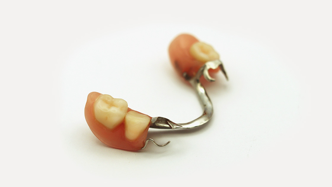 Eine Zahn-Teillprothese